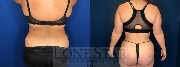 Before & After Tummy Tuck Case 142 Back View in Frisco, TX