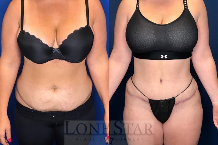 Before & After Tummy Tuck Case 142 Front View in Frisco, TX