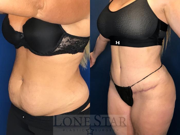 Before & After Tummy Tuck Case 142 Left Oblique View in Frisco, TX