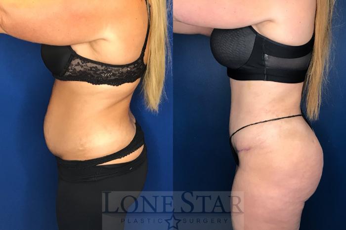 Before & After Tummy Tuck Case 142 Left Side View in Frisco, TX
