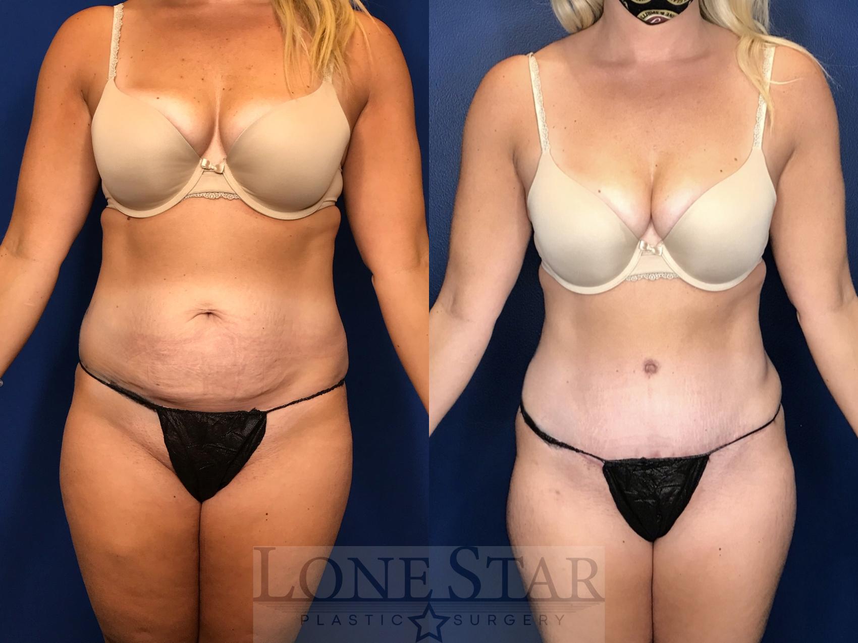 Before & After Tummy Tuck Case 156 Front View in Frisco, TX