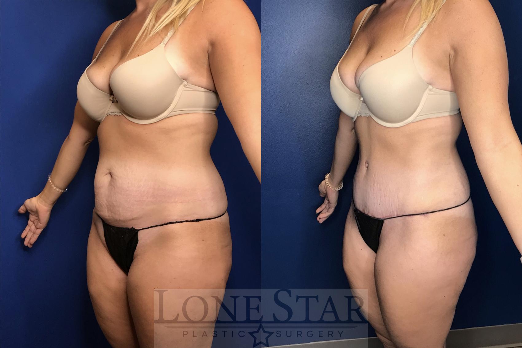 Before & After Tummy Tuck Case 156 Left Oblique View in Frisco, TX