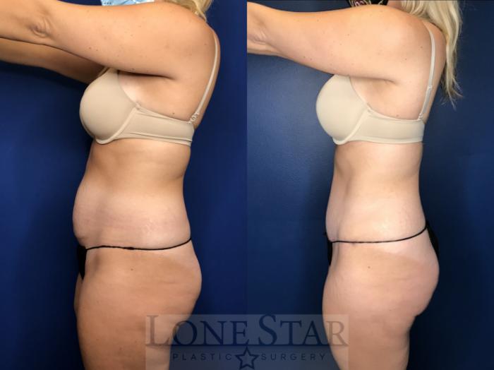 Before & After Tummy Tuck Case 156 Left Side View in Frisco, TX