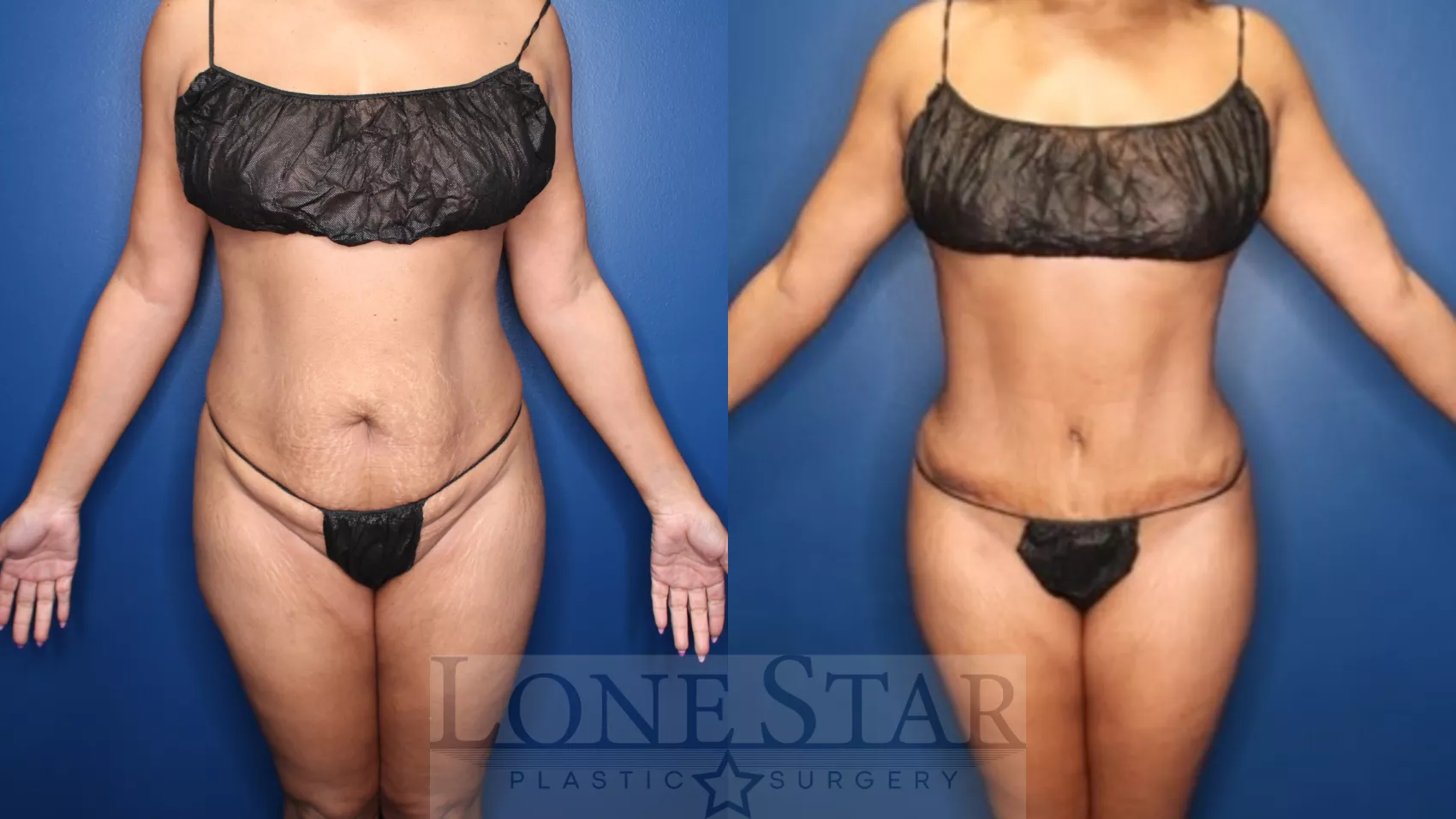 Tummy Tuck Before and After Pictures Case 178, Frisco, TX
