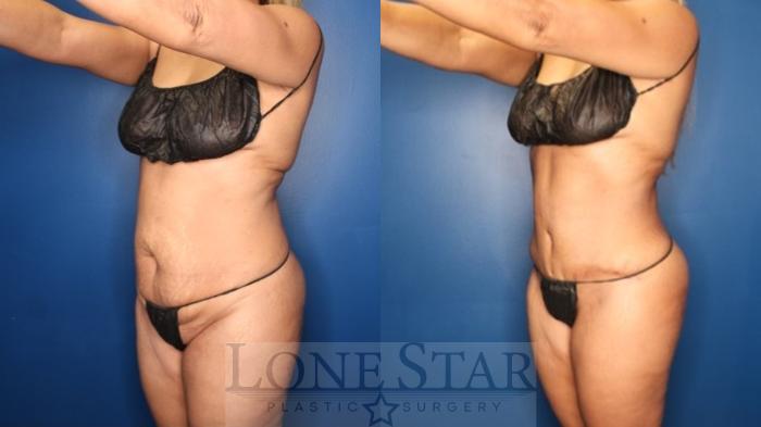 Before & After Tummy Tuck Case 178 Left Oblique View in Frisco, TX