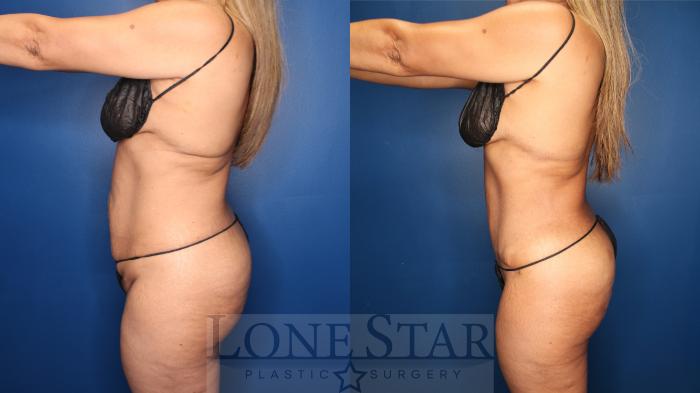 Before & After Tummy Tuck Case 178 Left Side View in Frisco, TX