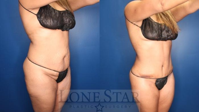Before & After Tummy Tuck Case 178 Right Oblique View in Frisco, TX