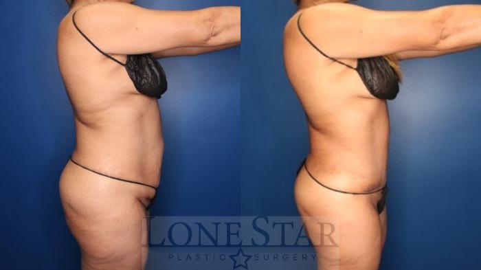 Before & After Tummy Tuck Case 178 Right Side View in Frisco, TX