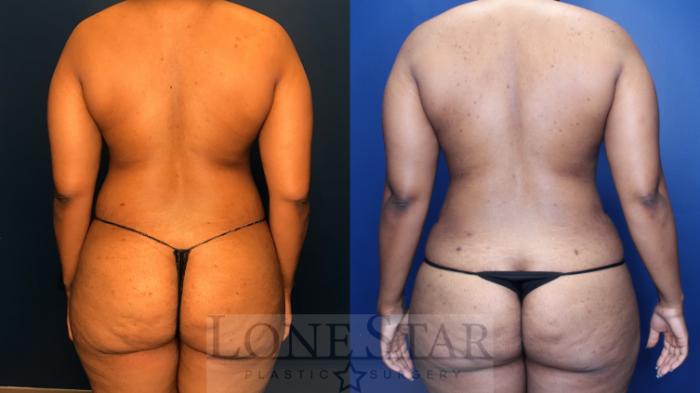Before & After Liposuction Case 180 Back View in Frisco, TX