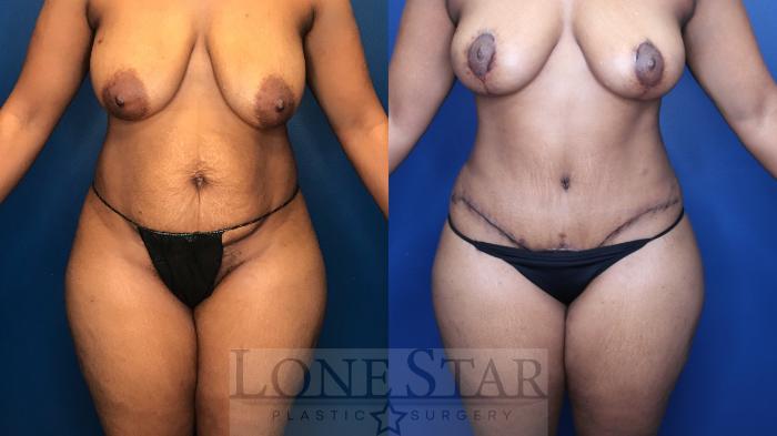 Before & After Liposuction Case 180 Front View in Frisco, TX