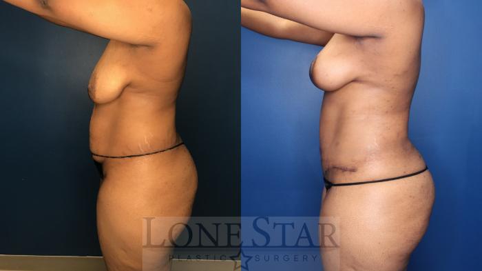 Before & After Liposuction Case 180 Left Side View in Frisco, TX