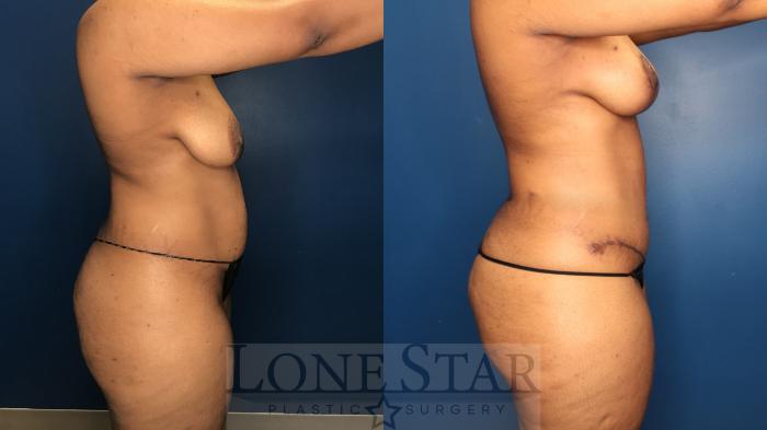 Before & After Liposuction Case 180 Right Side View in Frisco, TX