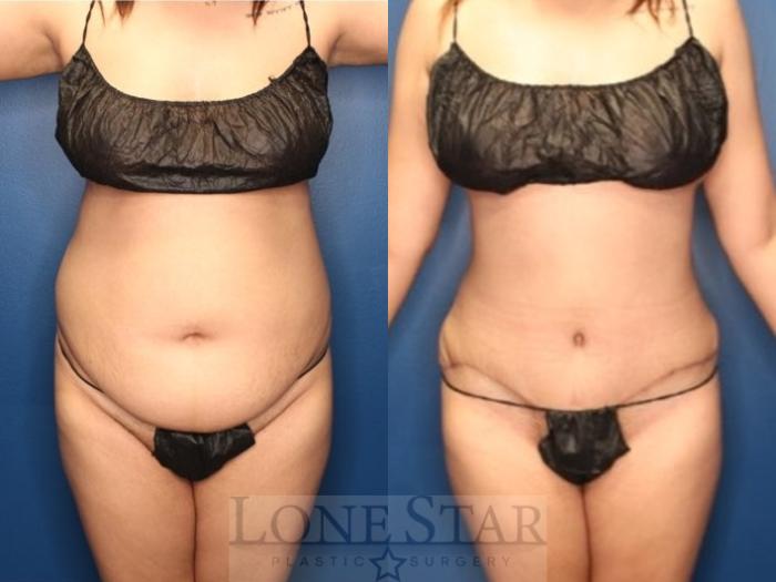 Before & After Tummy Tuck Case 185 Front View in Frisco, TX
