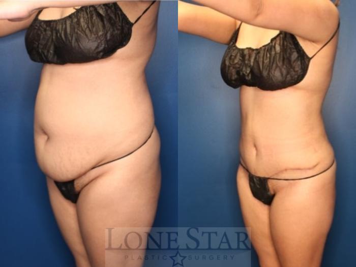 Before & After Tummy Tuck Case 185 Left Oblique View in Frisco, TX