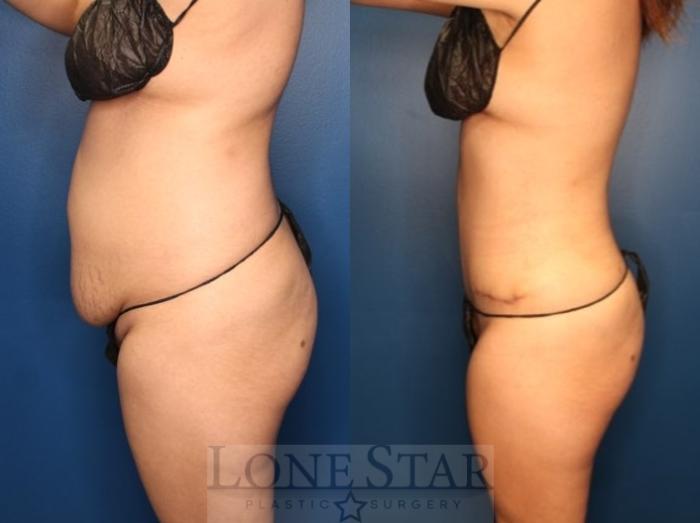 Before & After Liposuction Case 185 Left Side View in Frisco, TX