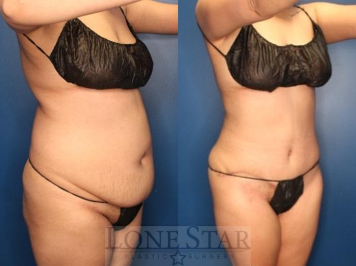 Before & After Tummy Tuck Case 185 Right Oblique View in Frisco, TX