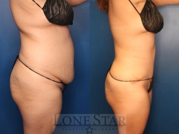 Before & After Liposuction Case 185 Right Side View in Frisco, TX