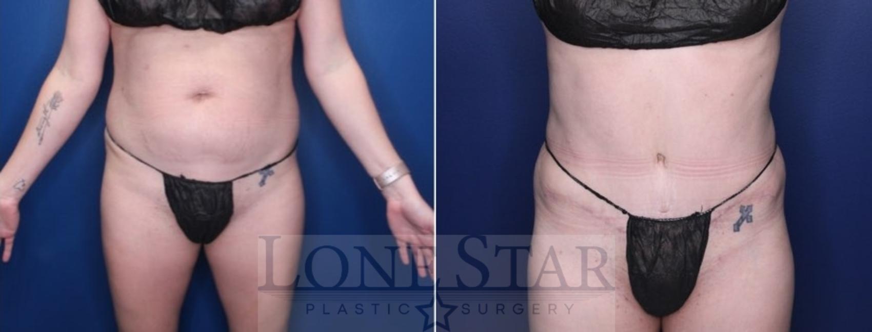 Before & After Tummy Tuck Case 206 Front View in Frisco, TX