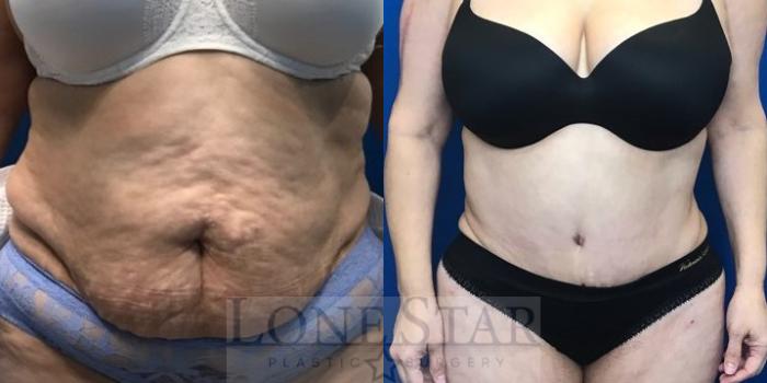 Before & After Tummy Tuck Case 26 View #1 View in Frisco, TX