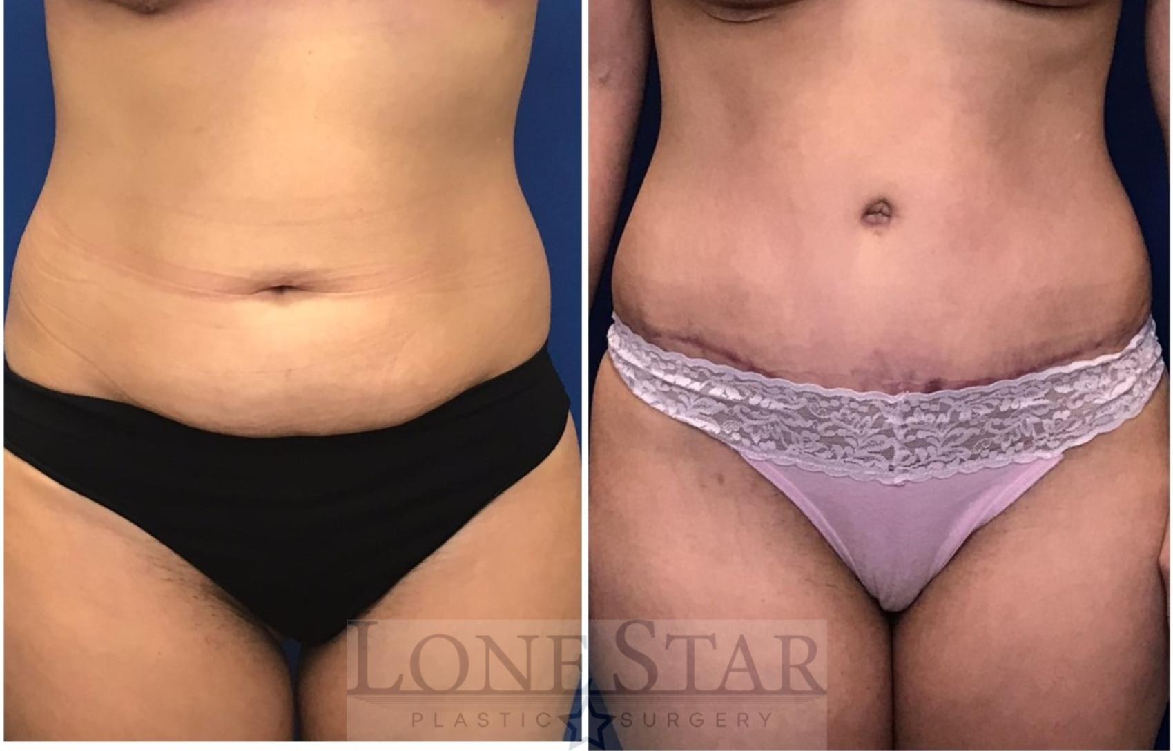 Before & After Liposuction Case 32 View #1 View in Frisco, TX