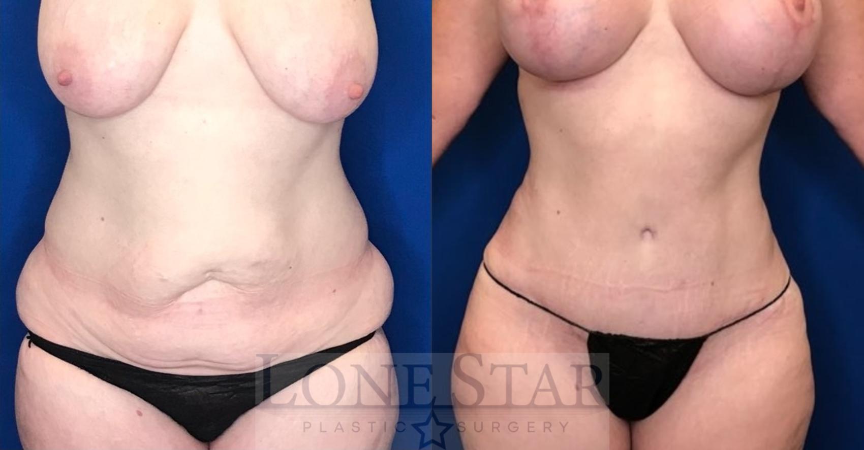 Before & After Liposuction Case 47 Front View in Frisco, TX