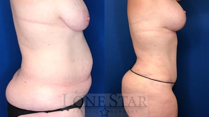 Before & After Tummy Tuck Case 47 Left Side View in Frisco, TX