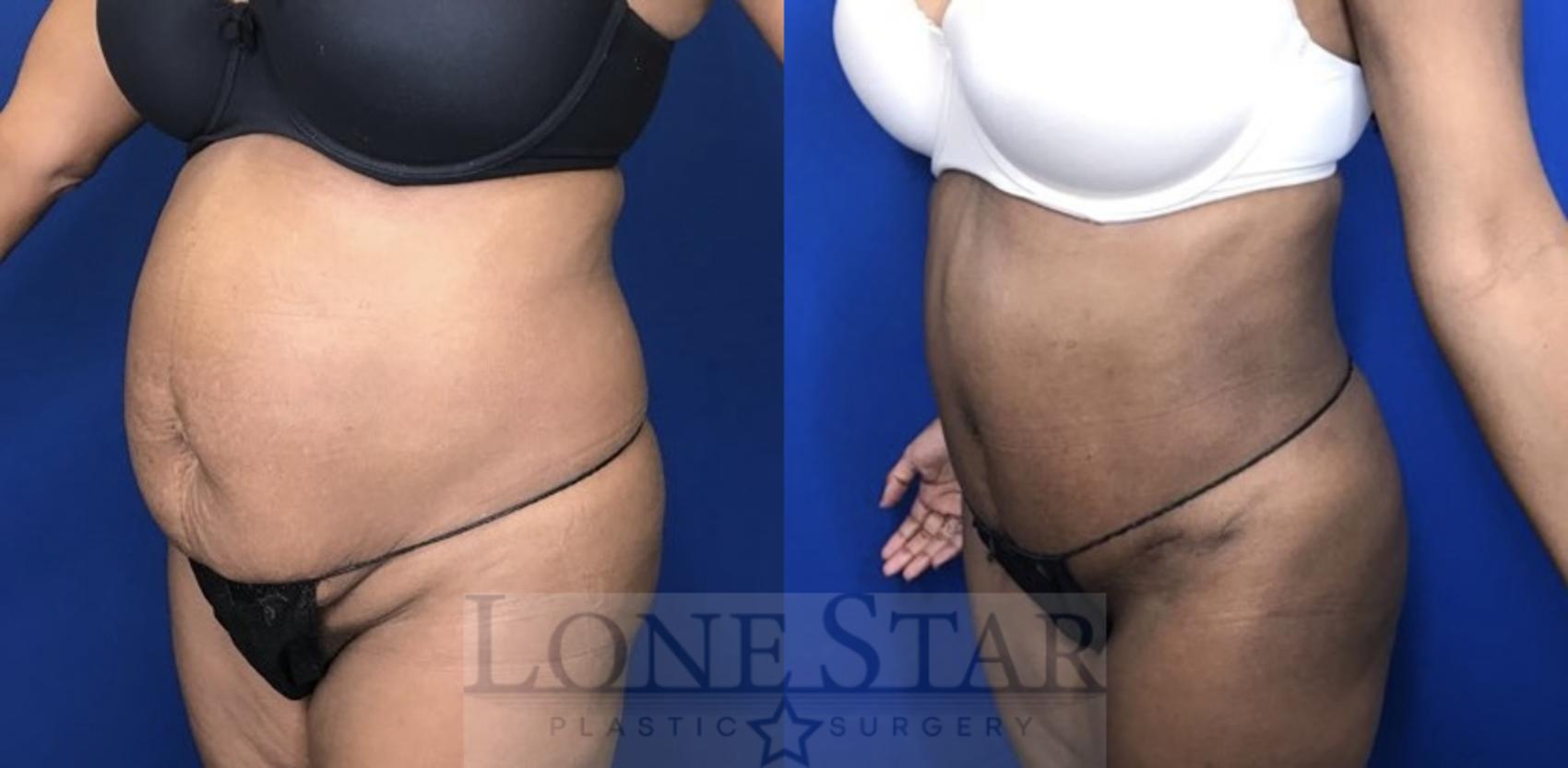 Before & After Tummy Tuck Case 54 Left Oblique View in Frisco, TX