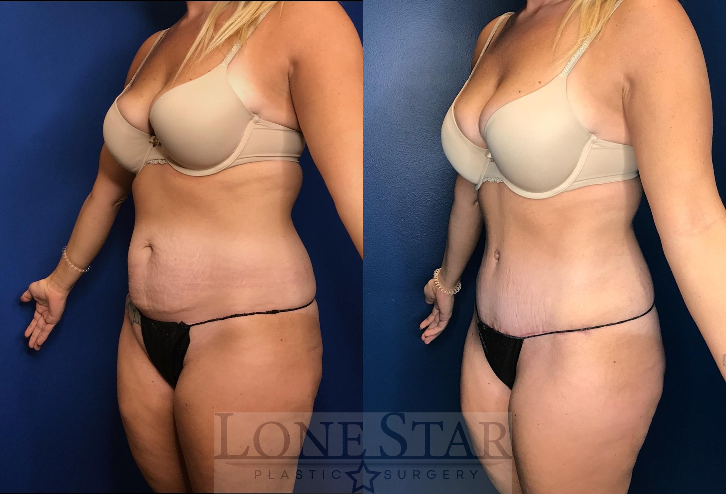 Before & After Tummy Tuck Case 59 Left Oblique View in Frisco, TX