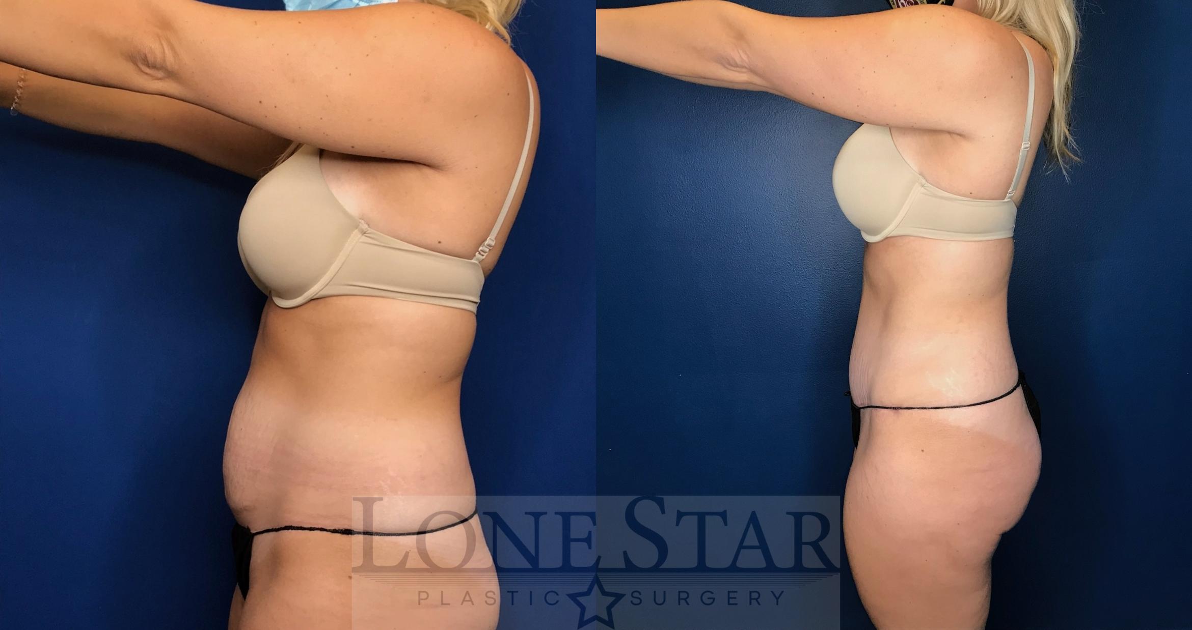 Before & After Tummy Tuck Case 59 Left Side View in Frisco, TX