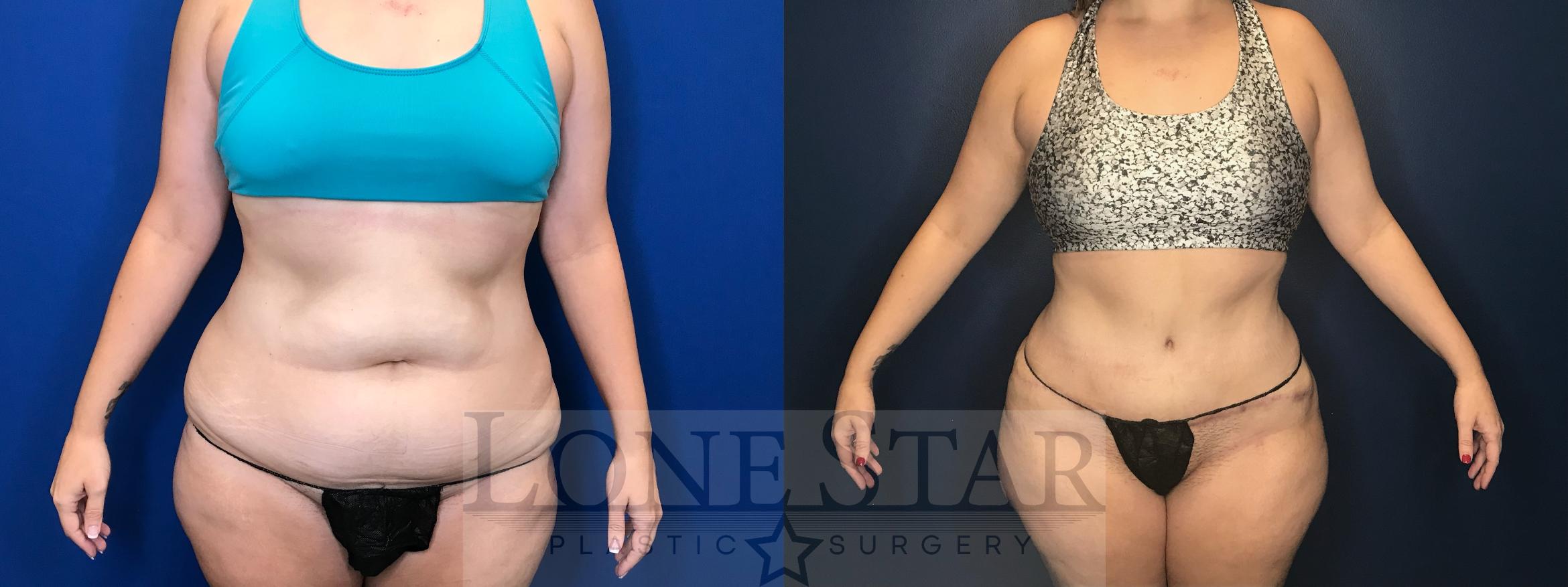 Before & After Tummy Tuck Case 61 Front View in Frisco, TX