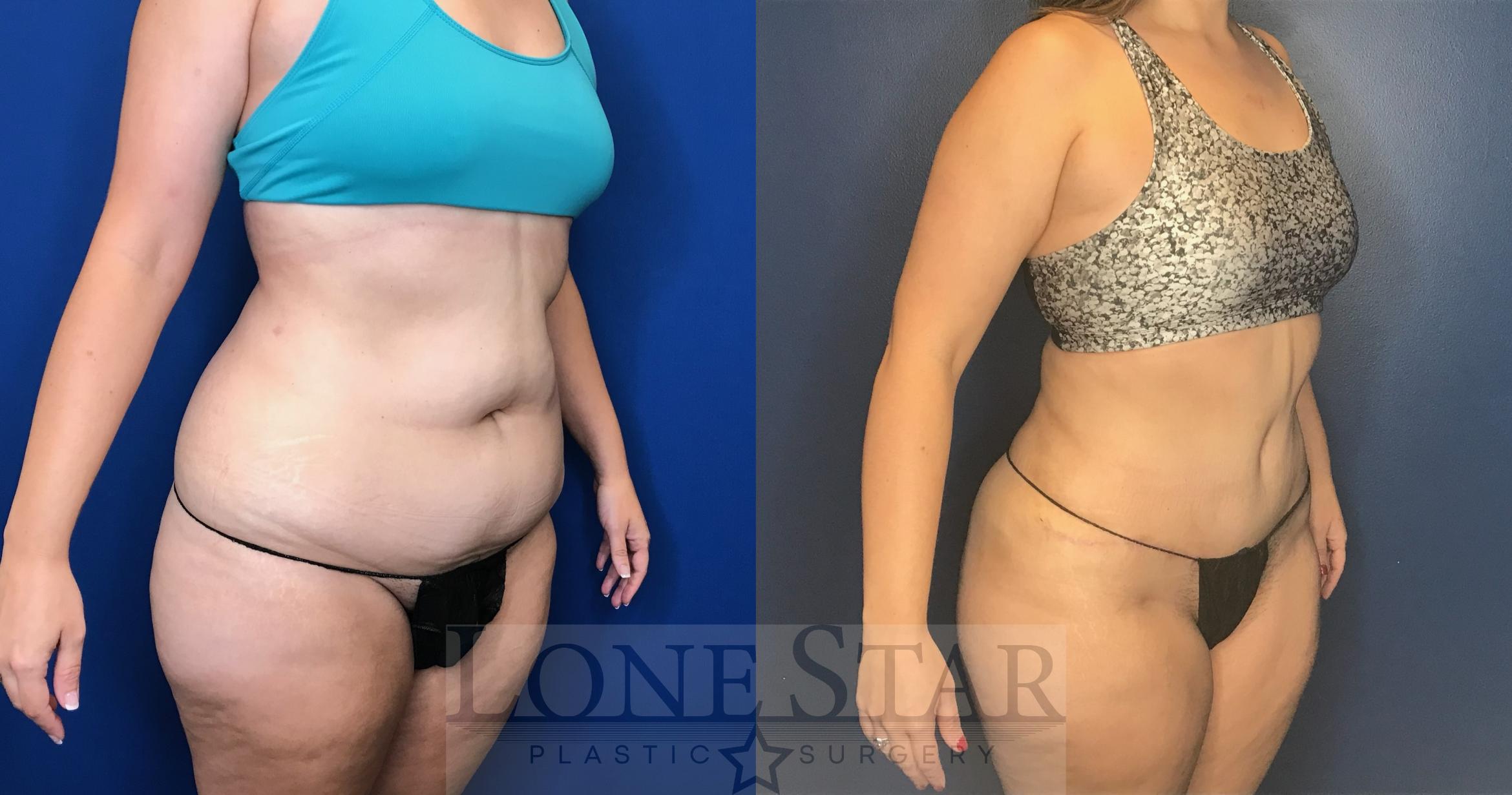 Before & After Tummy Tuck Case 61 Right Oblique View in Frisco, TX