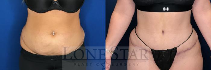 Before & After Tummy Tuck Case 66 Front View in Frisco, TX