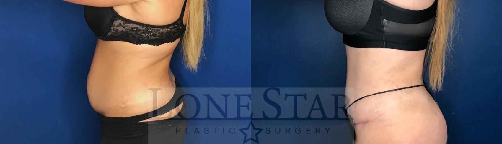 Before & After Tummy Tuck Case 66 Left Side View in Frisco, TX