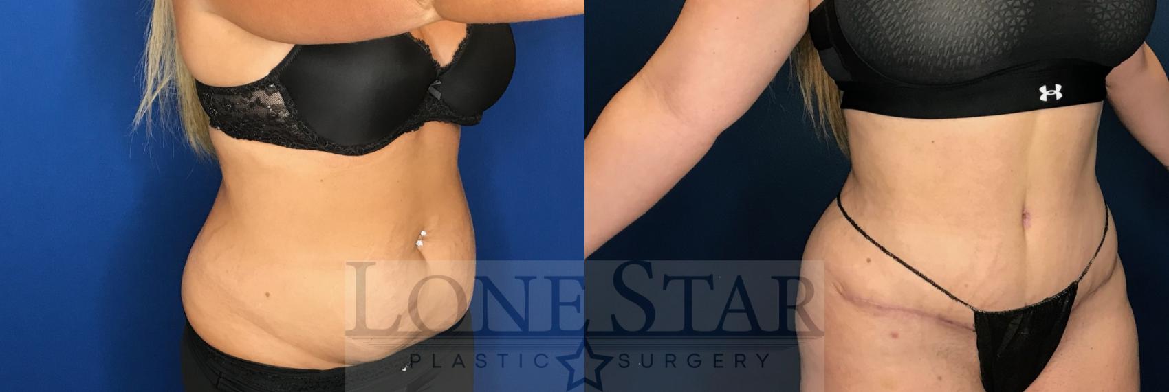 Before & After Tummy Tuck Case 66 Right Oblique View in Frisco, TX