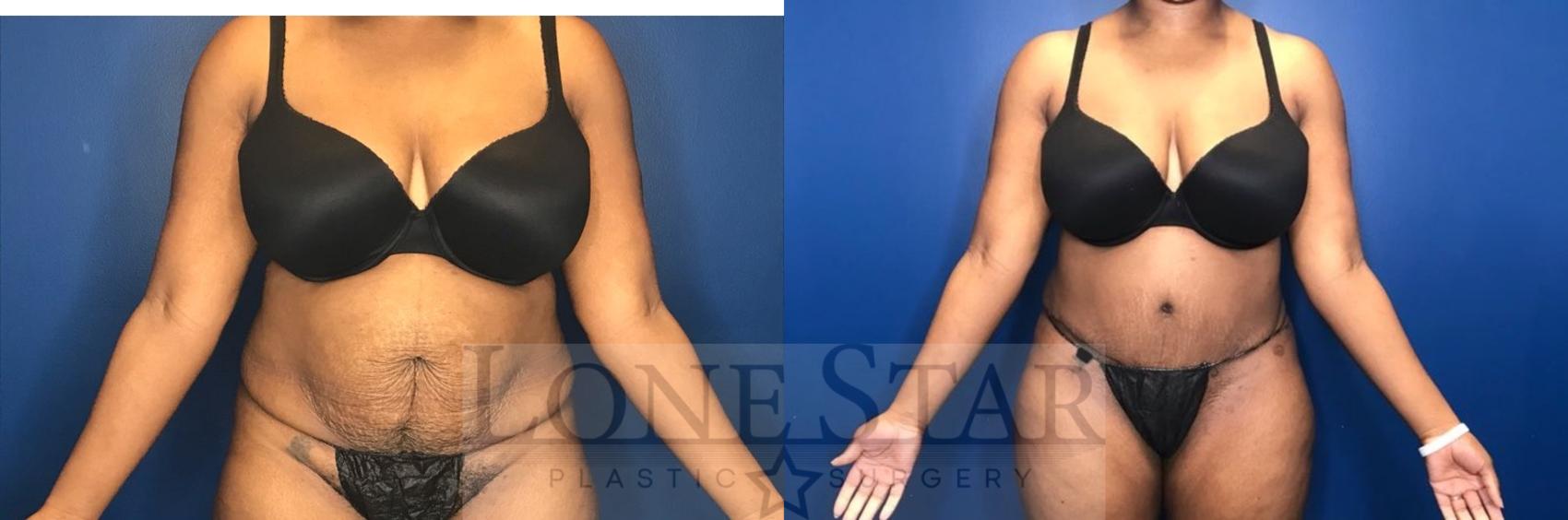 Before & After Tummy Tuck Case 70 Front View in Frisco, TX