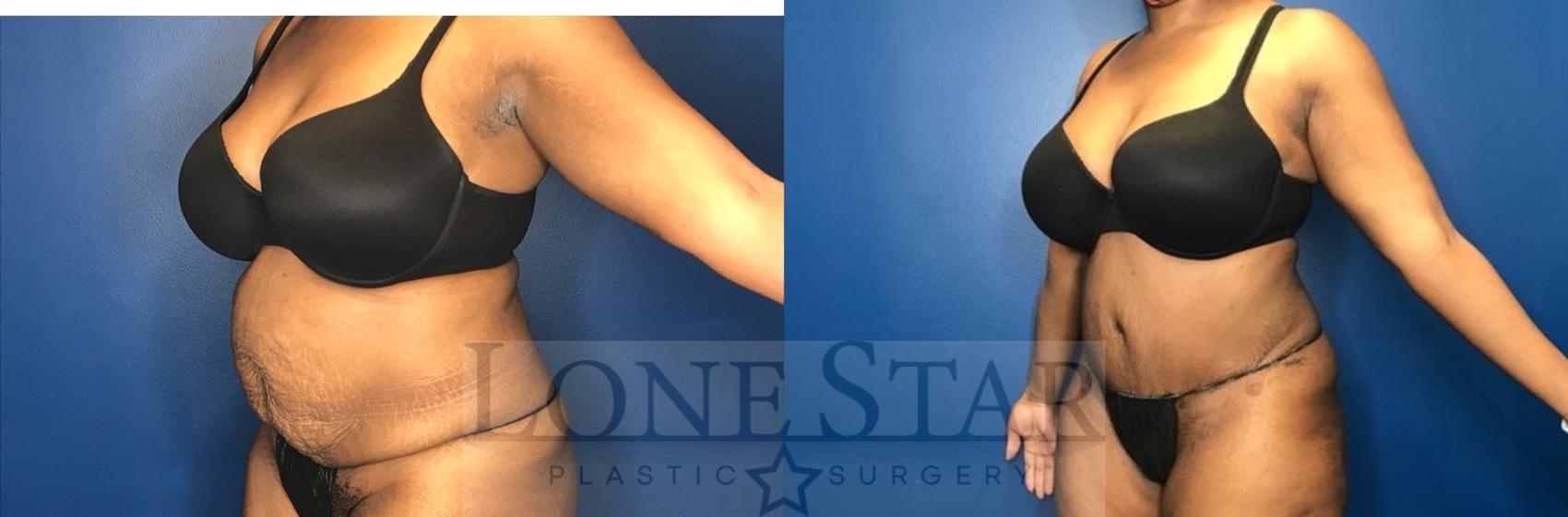 Before & After Tummy Tuck Case 70 Left Oblique View in Frisco, TX