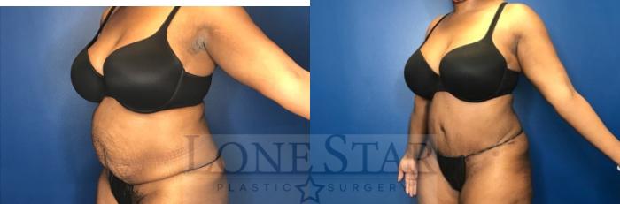 Before & After Mommy Makeover Case 70 Left Oblique View in Frisco, TX