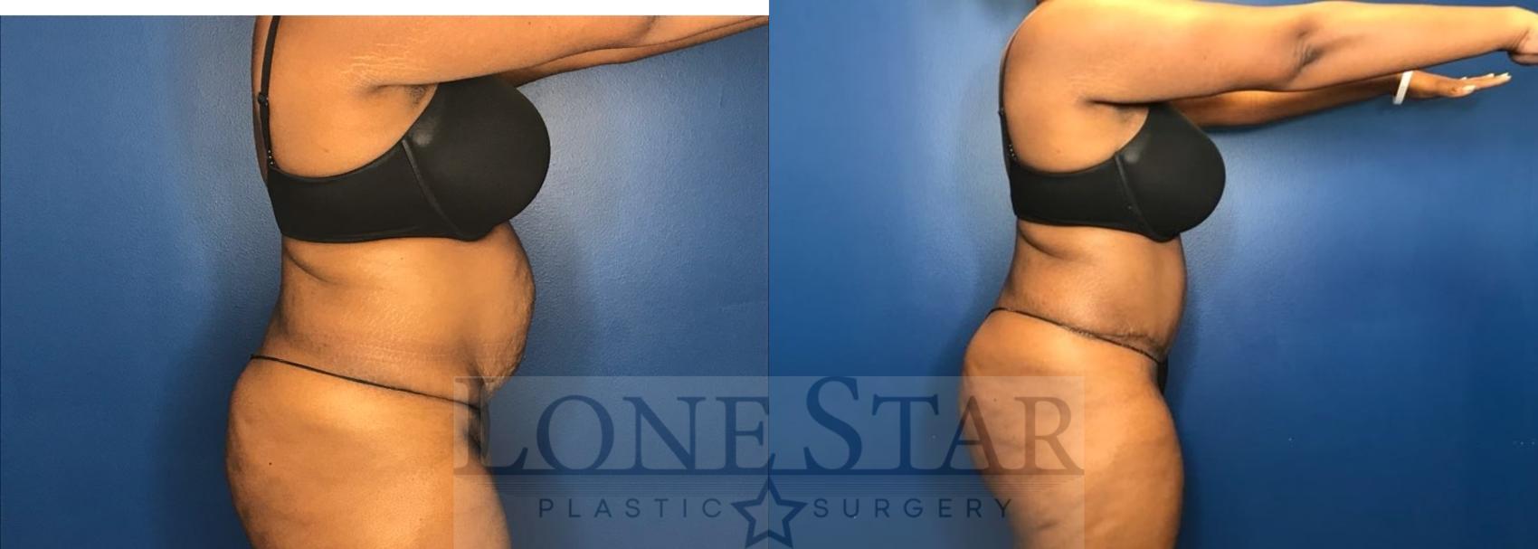 Before & After Tummy Tuck Case 70 Right Side View in Frisco, TX