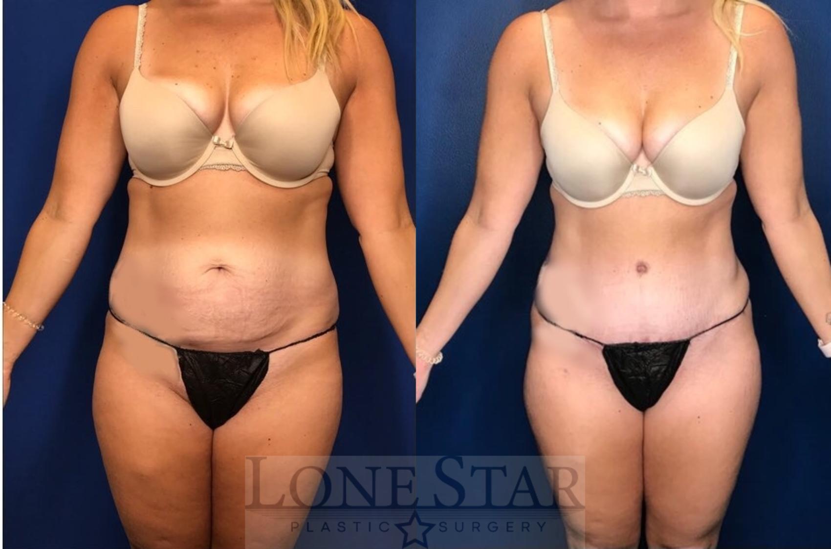 Before & After Tummy Tuck Case 87 Front View in Frisco, TX